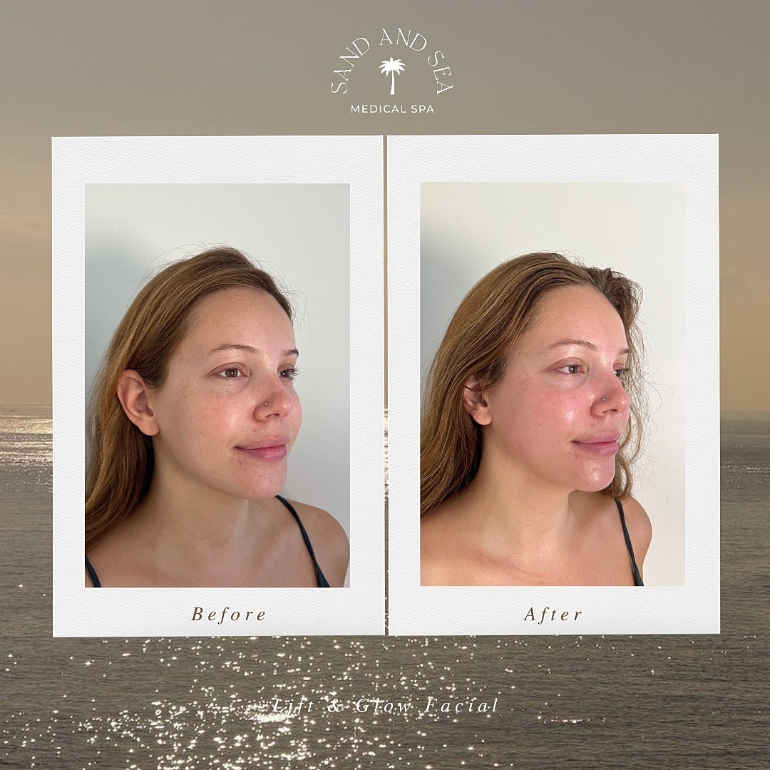Facial treatment results: before and after comparison.