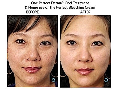 Before and after skin treatment result comparison.