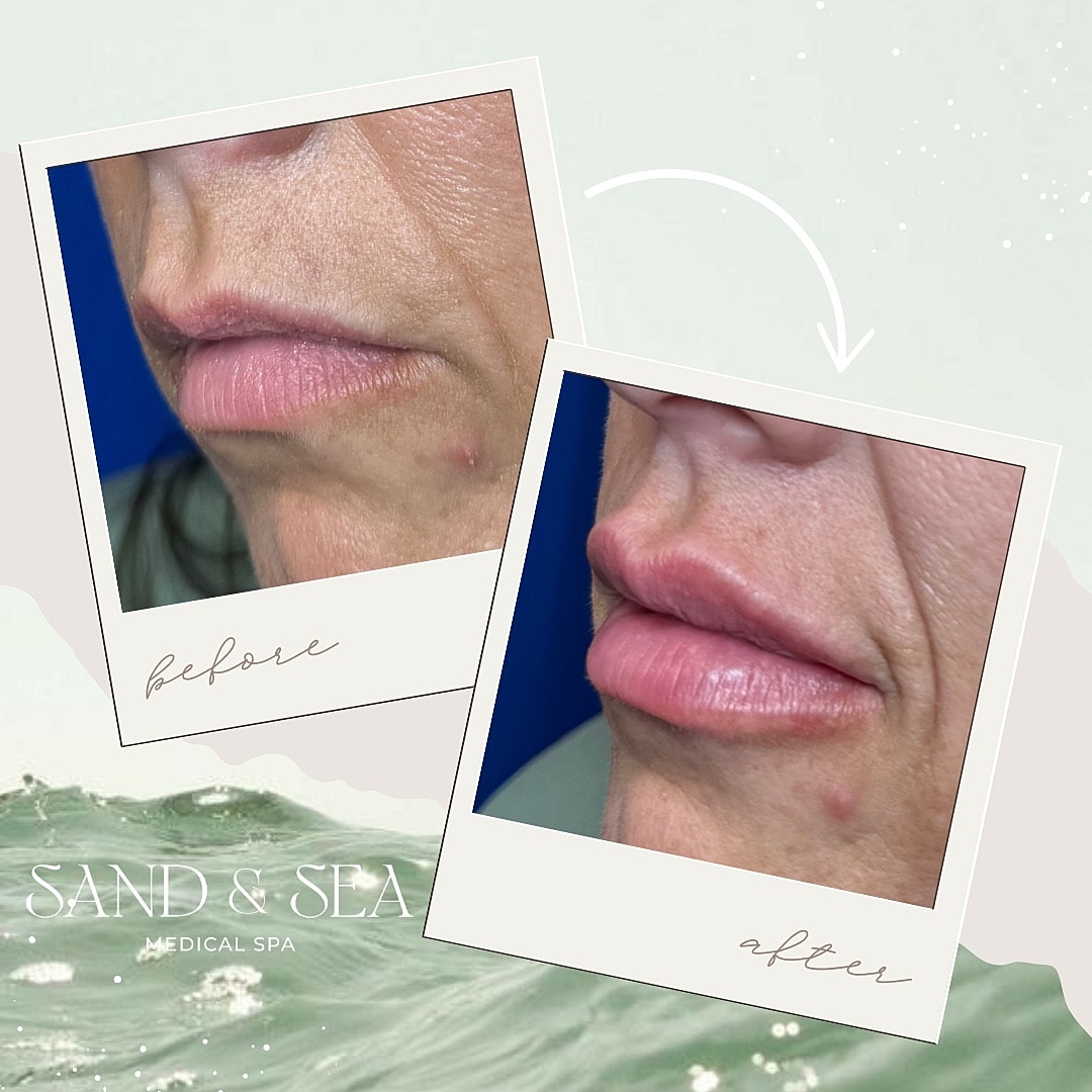 Before and after lip enhancement photos