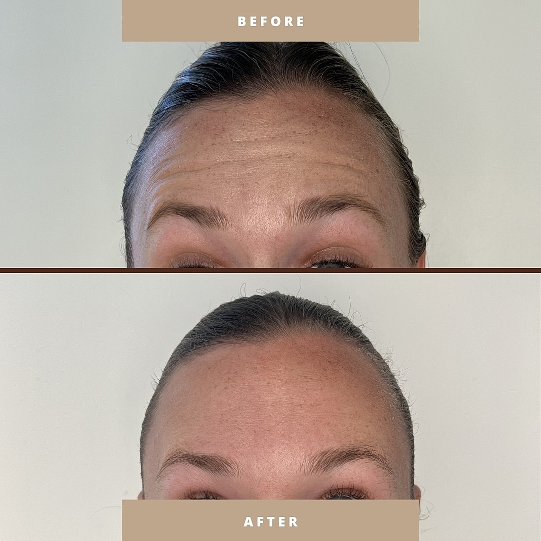 Before and after skincare results on forehead.
