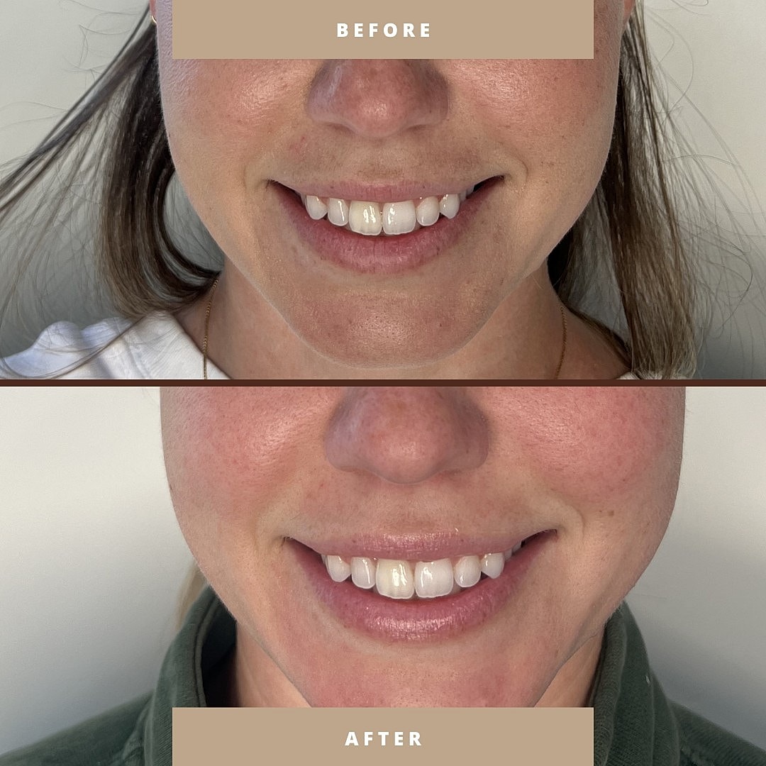 Smile transformation before and after comparison.