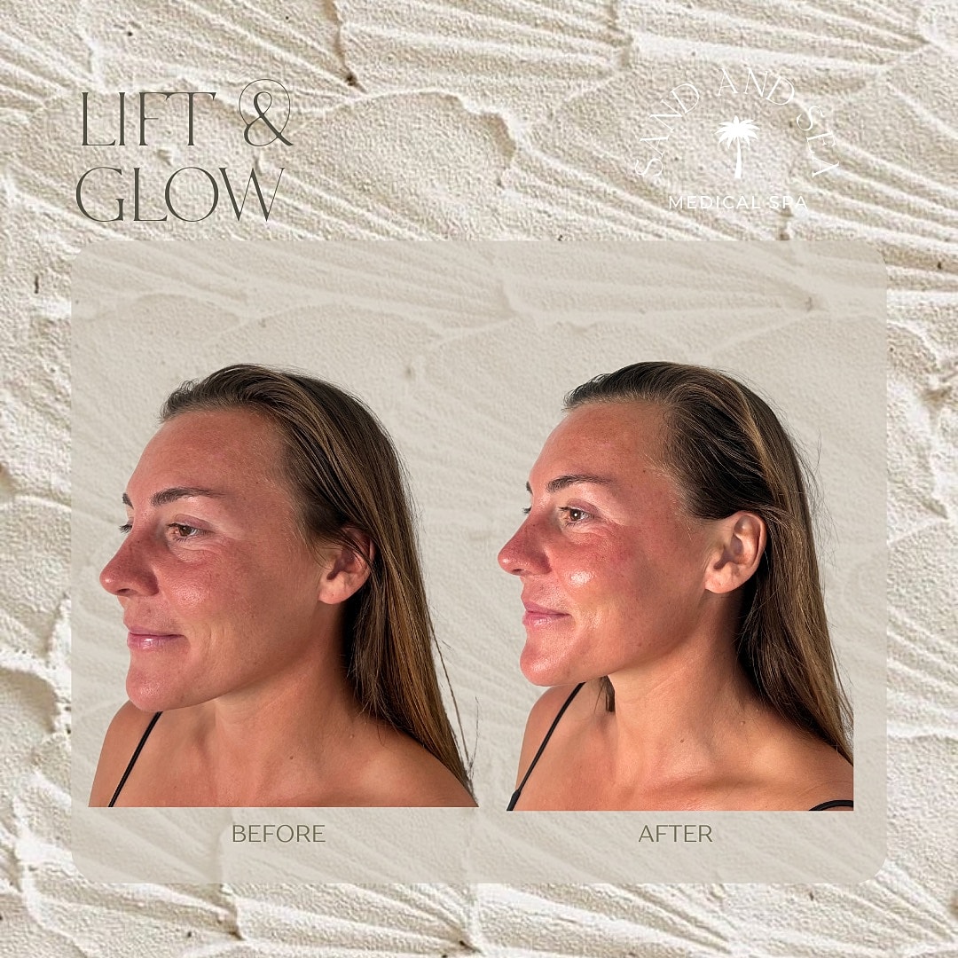 Facials Before & After