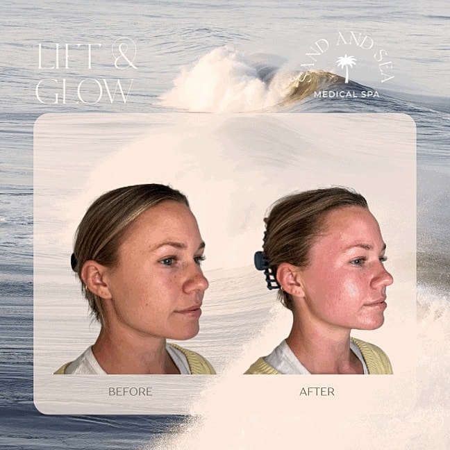 Facials Before & After